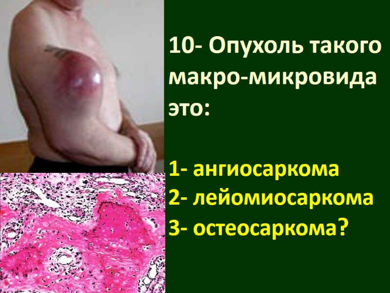 10- Опухоль такого макро-микровида это:  1- ангиосаркома 2- лейомиосаркома 3- остеосаркома?